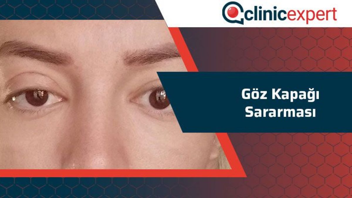 Goz Kapagi Sararmasi Clinicexpert Uluslararasi Saglik Hizmetleri