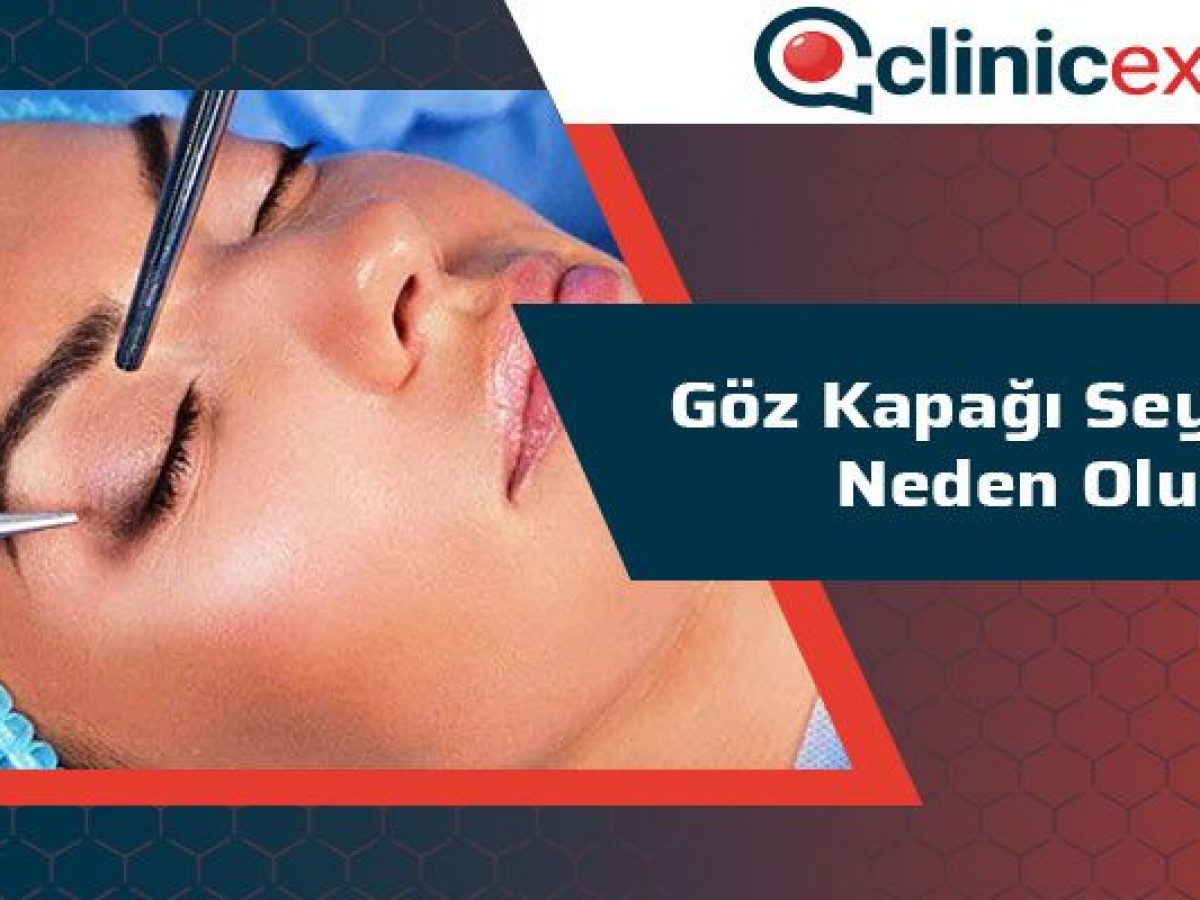 Goz Kapagi Segirmesi Neden Olur Goz Kapagi Segirmesi Neden Olur