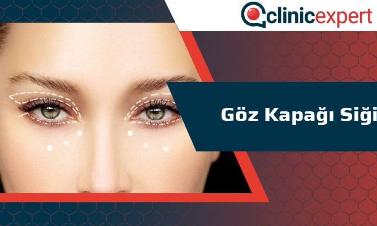 Goz Kapagi Sigil Clinicexpert Uluslararasi Saglik Hizmetleri