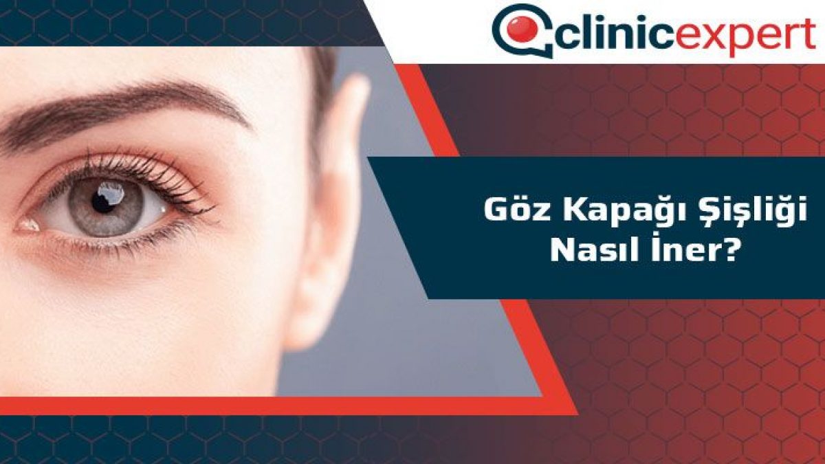 Goz Kapagi Sisligi Nasil Iner Goz Kapagi Sisligi Nasil Iner