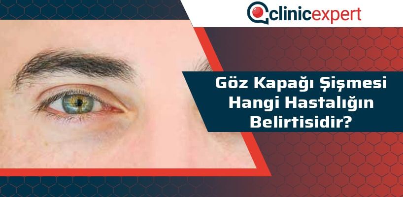 yüksek tansiyon ile göz altı şişmesi