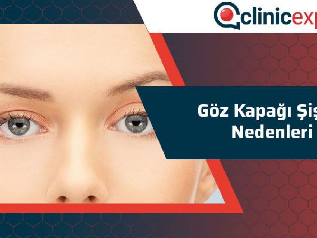 Goz Kapagi Sismesi Nedenleri Clinicexpert Uluslararasi Saglik Hizmetleri