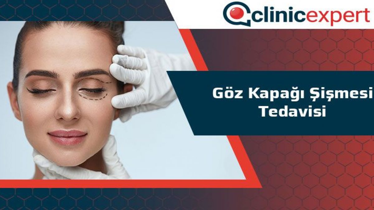 Goz Kapagi Sismesi Tedavi Clinicexpert Uluslararasi Saglik Hizmetleri