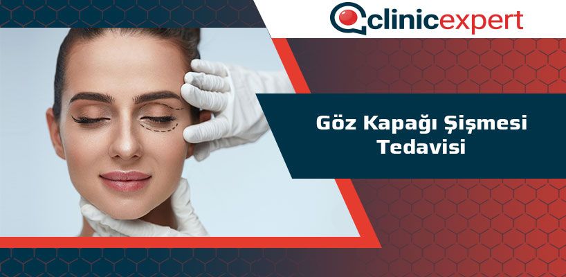 Göz Kapağı Şişmesi Tedavi