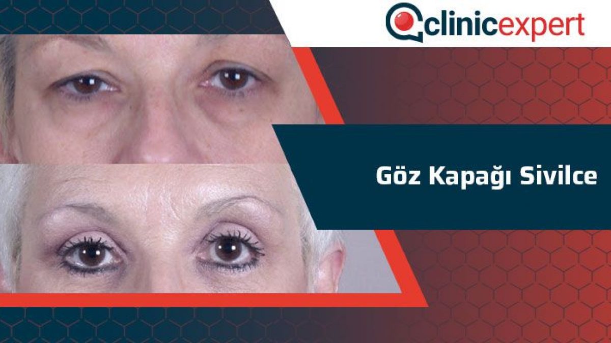 Goz Kapagi Sivilce Clinicexpert Uluslararasi Saglik Hizmetleri