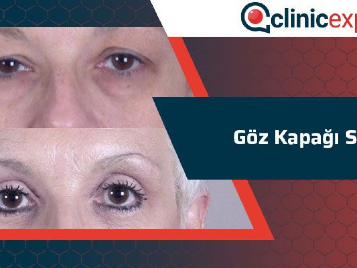 Goz Kapagi Sivilce Clinicexpert Uluslararasi Saglik Hizmetleri