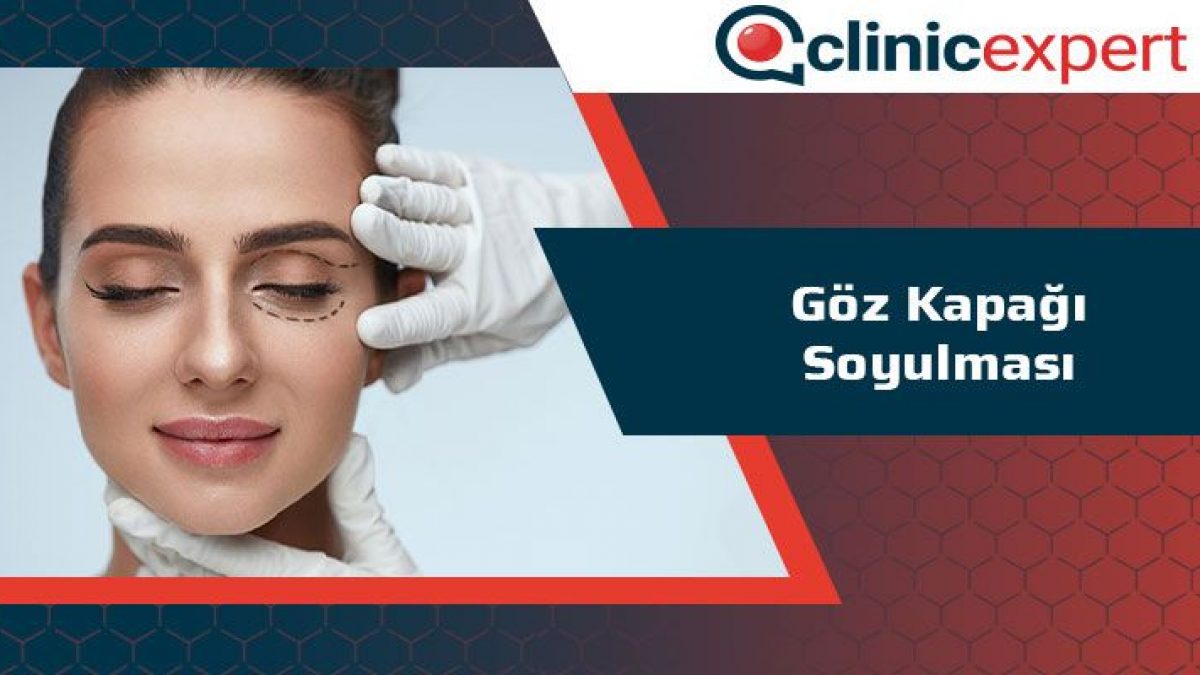 Goz Kapagi Soyulmasi Clinicexpert Uluslararasi Saglik Hizmetleri