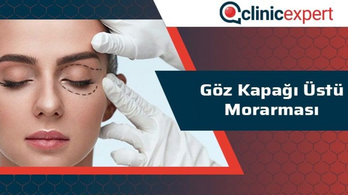goz kapagi ustu morarmasi clinicexpert uluslararasi saglik hizmetleri