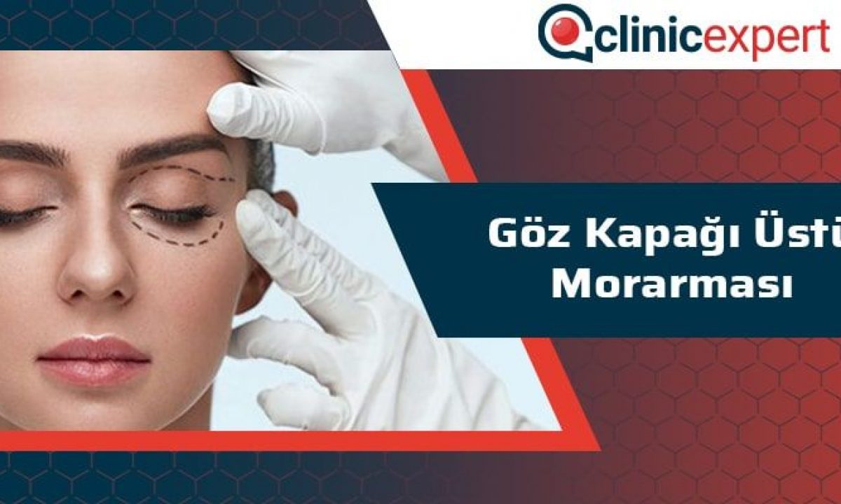 Goz Kapagi Ustu Morarmasi Clinicexpert Uluslararasi Saglik Hizmetleri