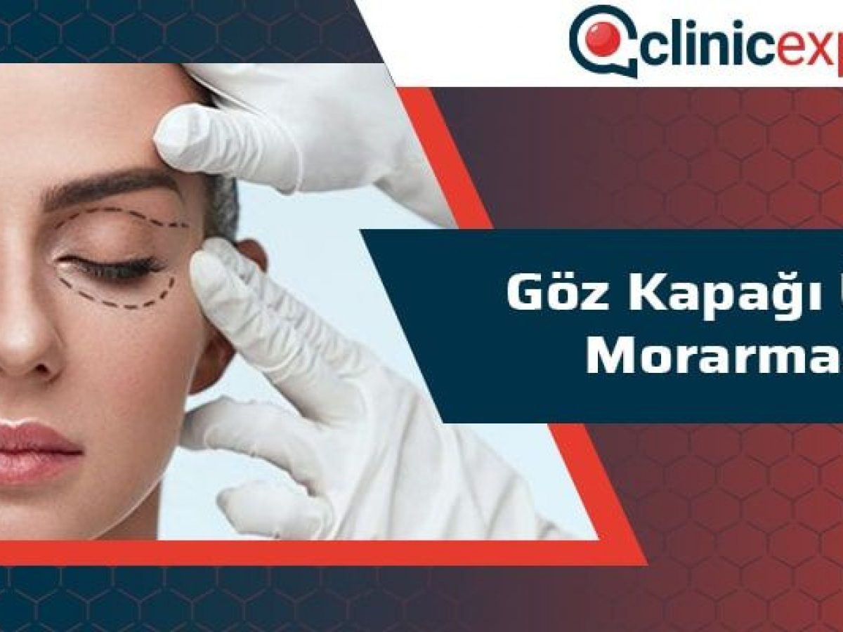 Goz Kapagi Ustu Morarmasi Clinicexpert Uluslararasi Saglik Hizmetleri