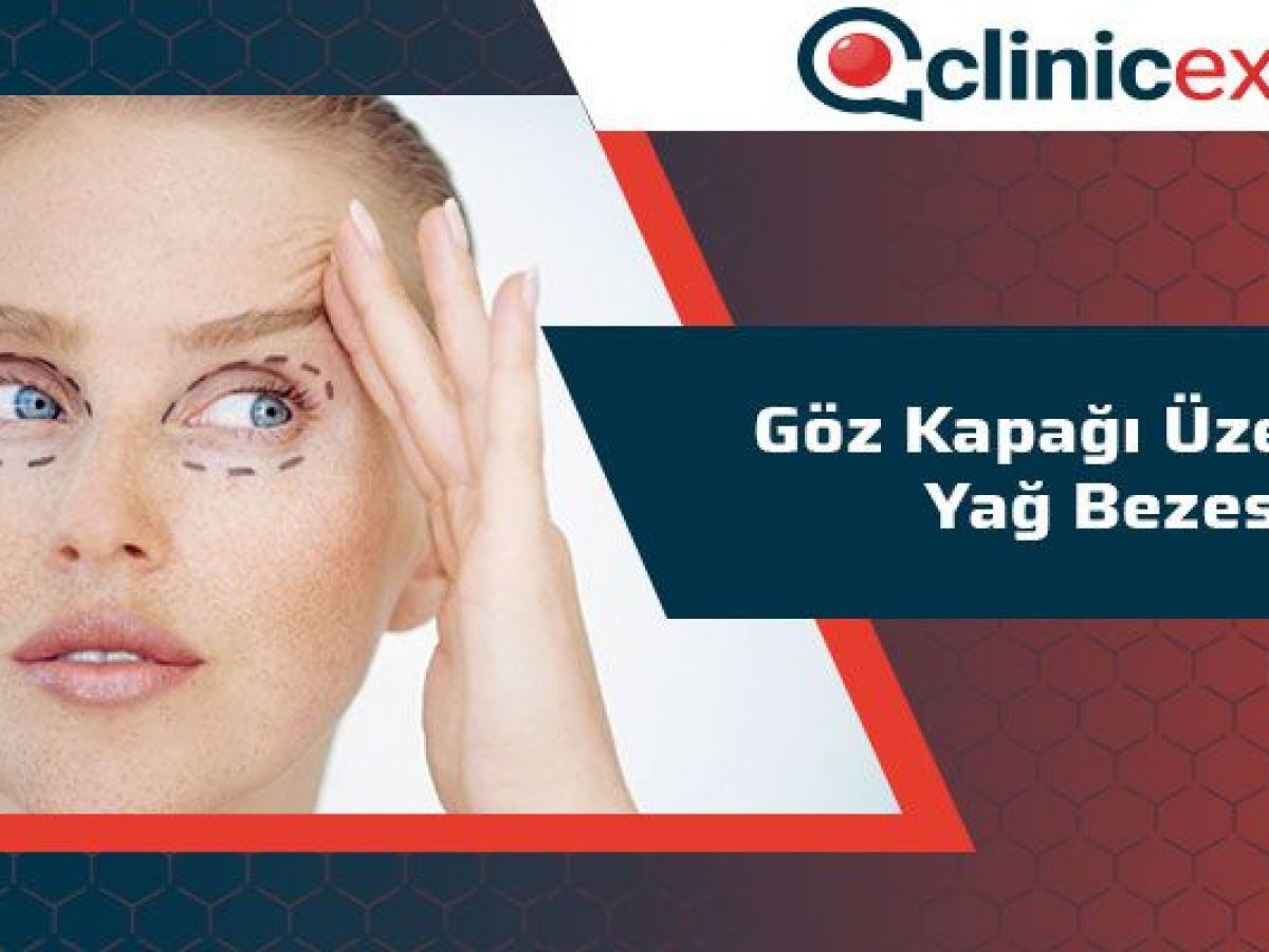 Goz Kapagi Uzerinde Yag Bezesi