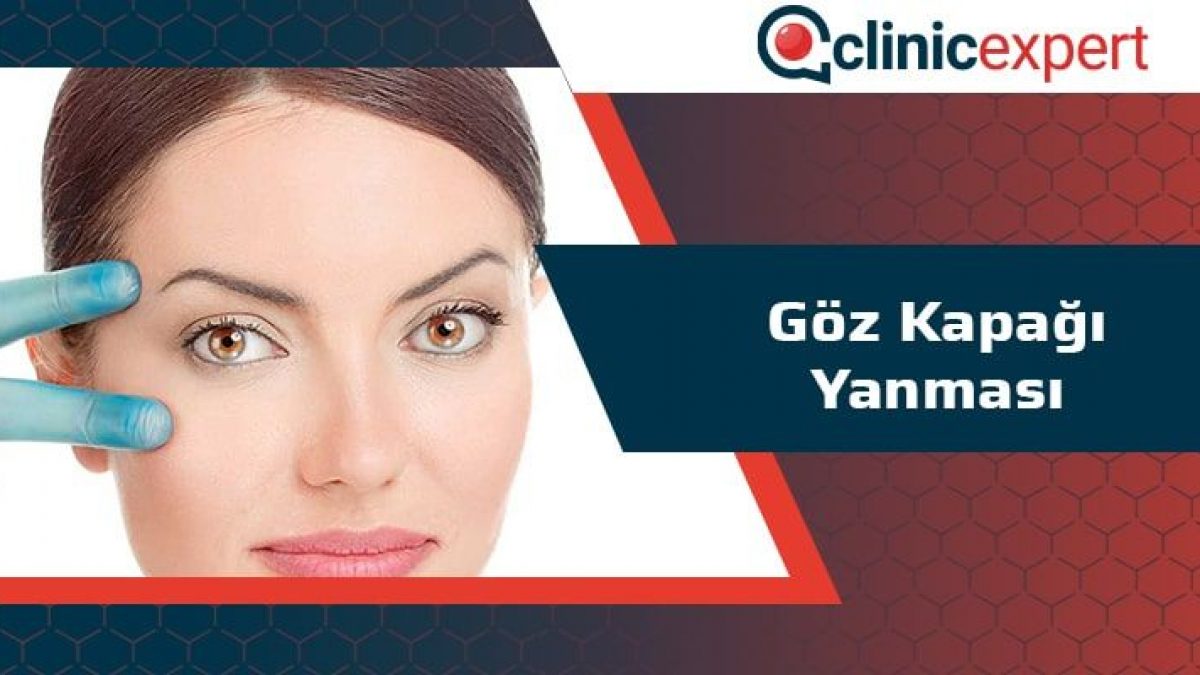 Goz Kapagi Yanmasi Clinicexpert Uluslararasi Saglik Hizmetleri