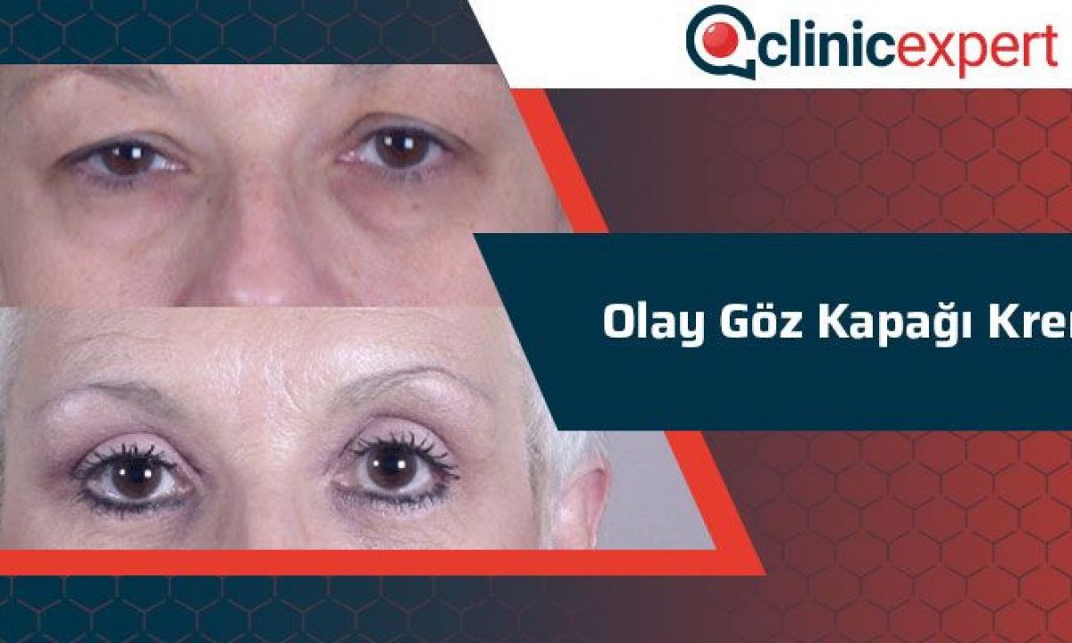 Olay Goz Kapagi Kremi Clinicexpert Uluslararasi Saglik Hizmetleri