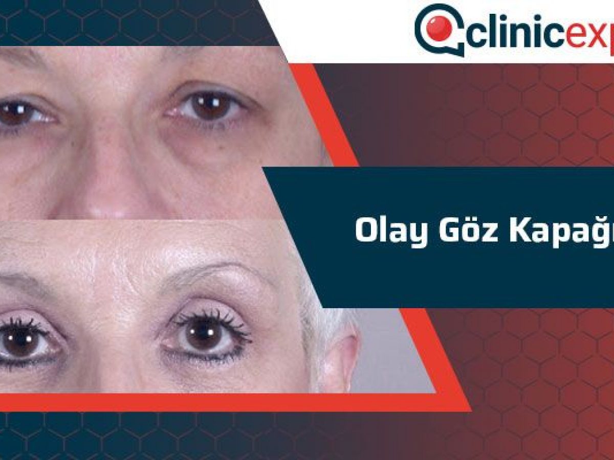 Olay Goz Kapagi Kremi Clinicexpert Uluslararasi Saglik Hizmetleri