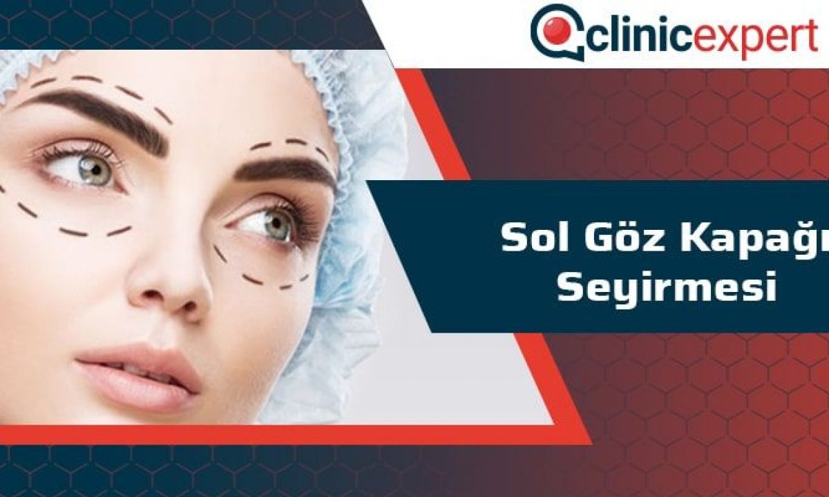 Sol Goz Kapagi Seyirmesi Clinicexpert Uluslararasi Saglik Hizmetleri Sol Goz Kapagi Seyirmesi Clinicexpert Uluslararasi Saglik Hizmetleri