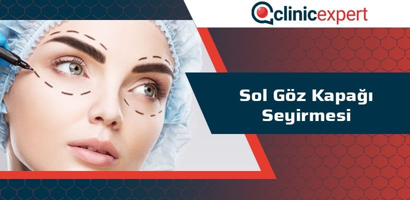 Sol Goz Kapagi Seyirmesi Clinicexpert Uluslararasi Saglik Hizmetleri