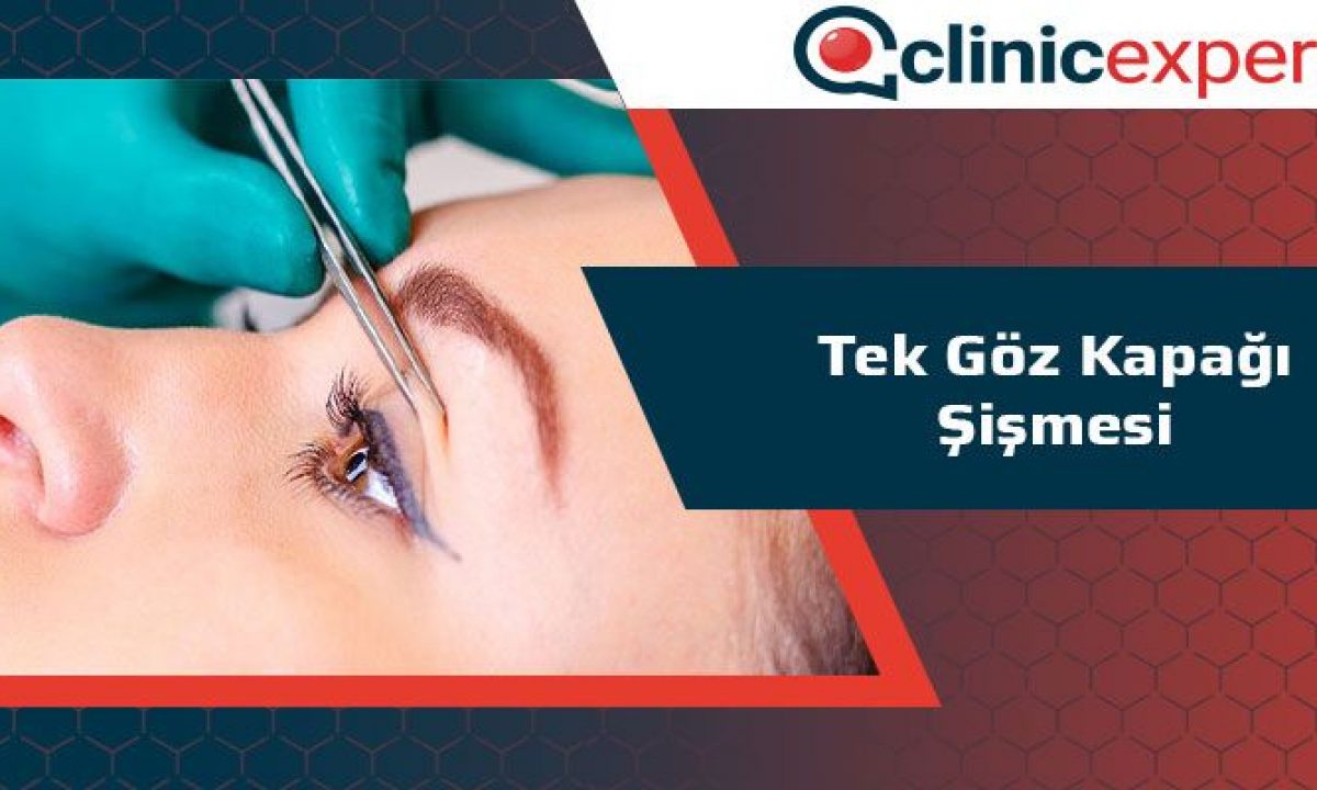 Tek Goz Kapagi Sismesi Clinicexpert Uluslararasi Saglik Hizmetleri