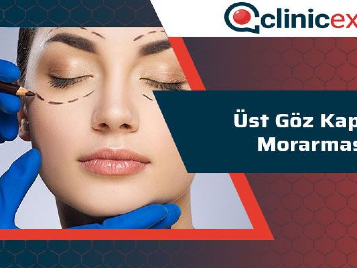 Goz Kapagi Morarmasi Clinicexpert Uluslararasi Saglik Hizmetleri