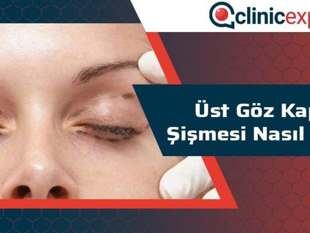 yüz göz şişkinliğine ne iyi gelir