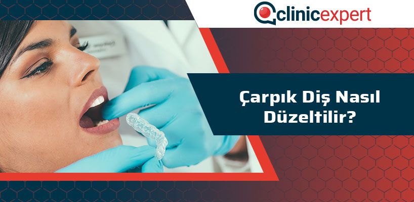 Çarpık Diş Nasıl Düzeltilir?