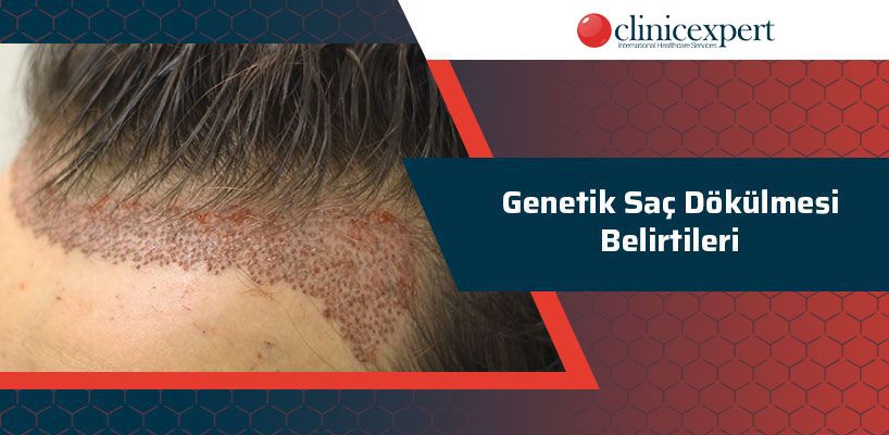 Genetik Saç Dökülmesi Belirtileri