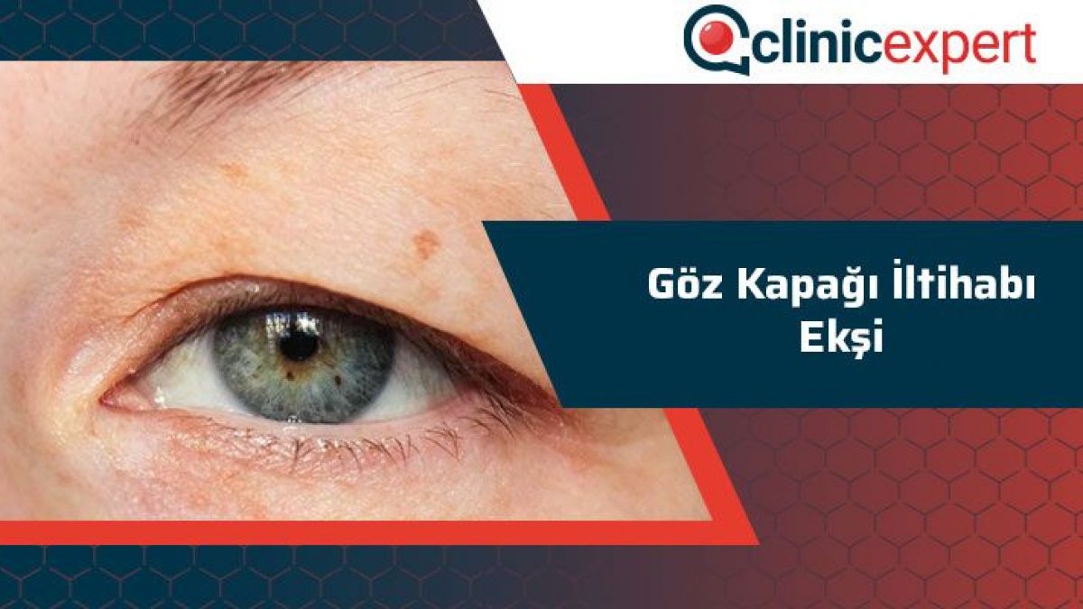 Goz Kapagi Iltihabi Eksi Uluslararasi Sac Ekimi Ve Estetik Saglik Hizmetleri Clinic Expert