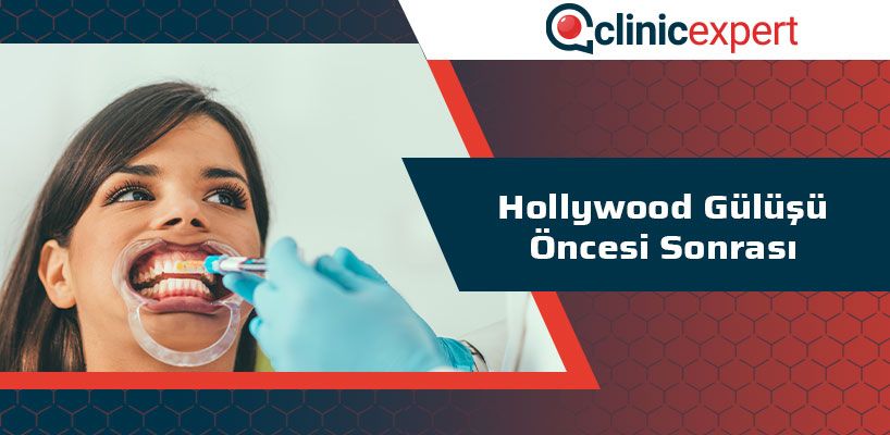 Hollywood Gülüşü Öncesi Sonrası