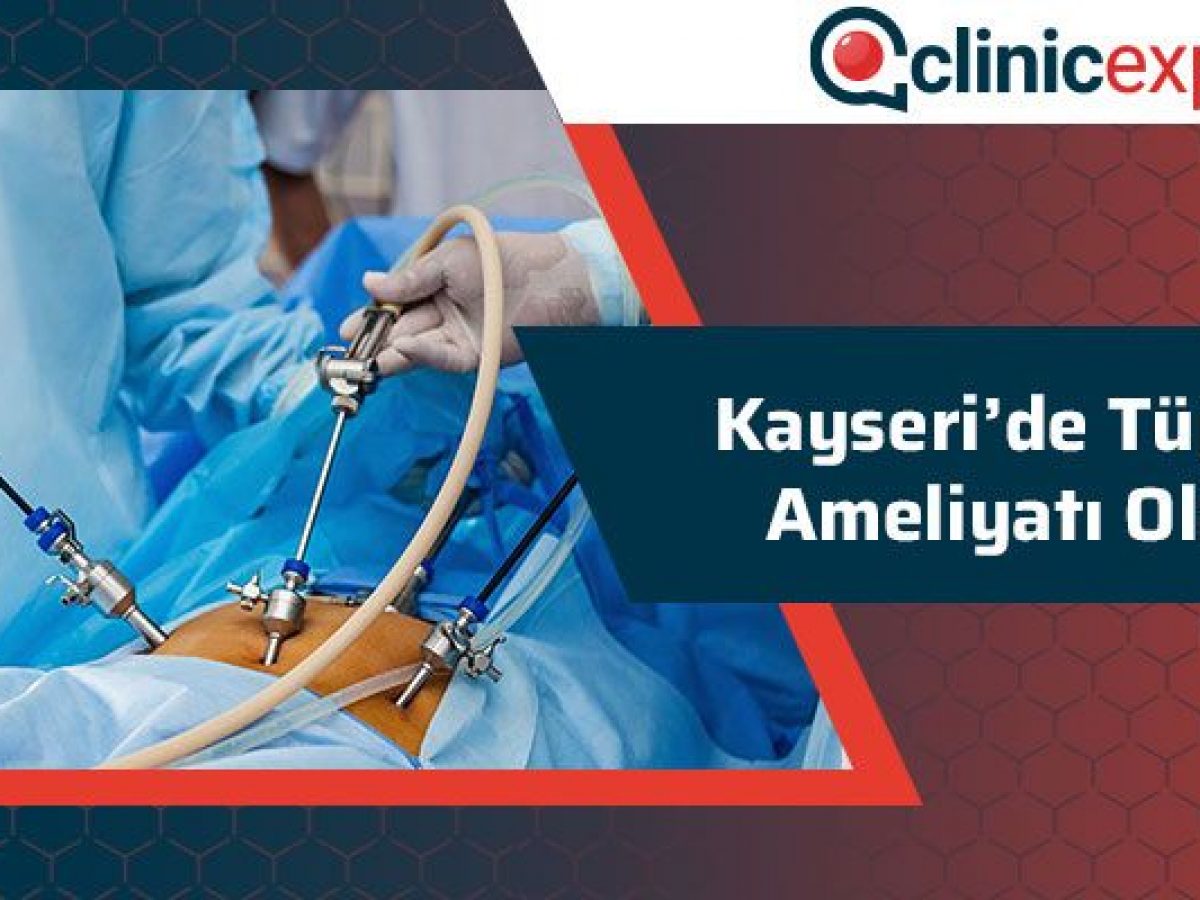 kayseri de tup mide ameliyati olanlar kayseri de tup mide ameliyati olanlar