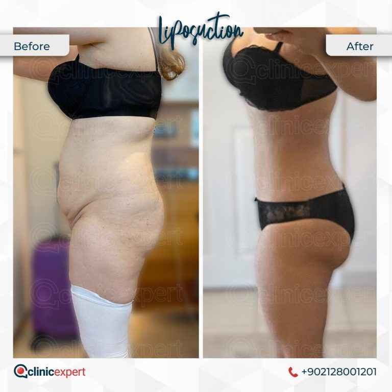 Liposuction (Liposakşın) Nedir? Liposuction Fiyatları