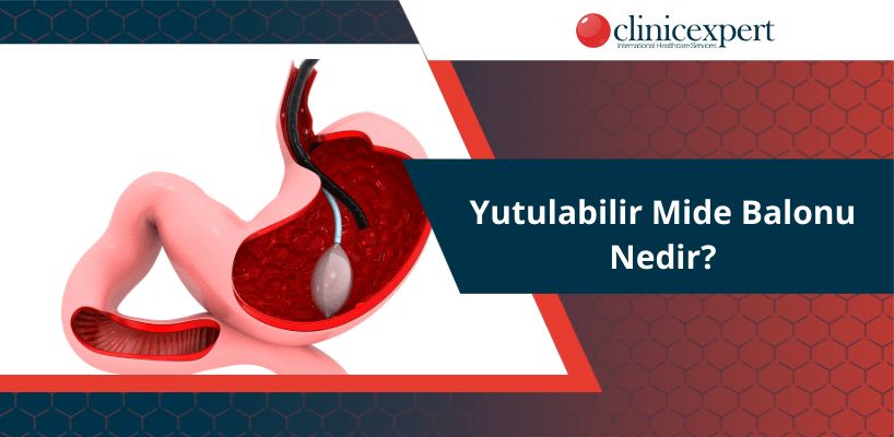 Yutulabilir Mide Balonu Nedir?