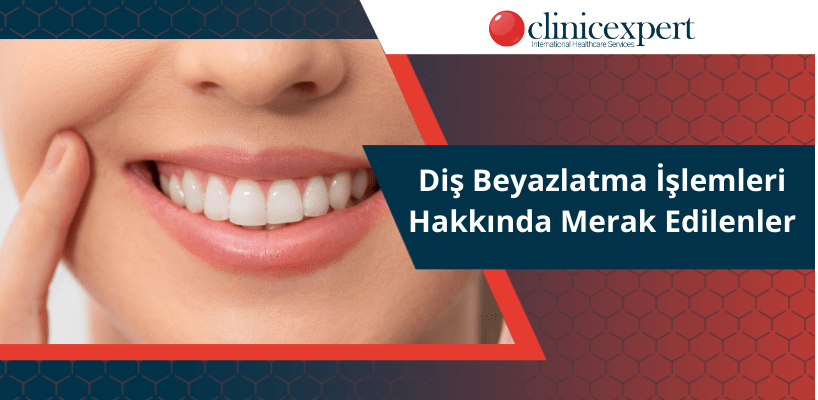 Diş Beyazlatma İşlemleri Hakkında Merak Edilenler