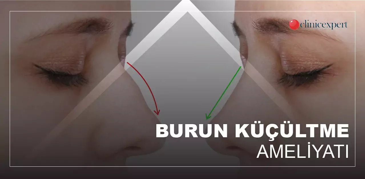 burun küçültme ameliyatı