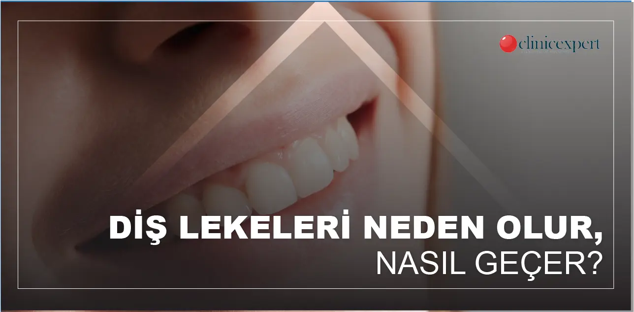 Diş Lekeleri Neden Olur, Nasıl Geçer?